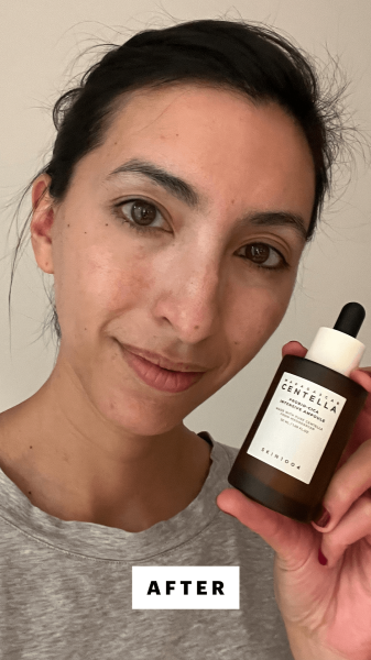 Pai after applying the Skin1004 Madagascar Centella ProbioCica Intensive Ampoule